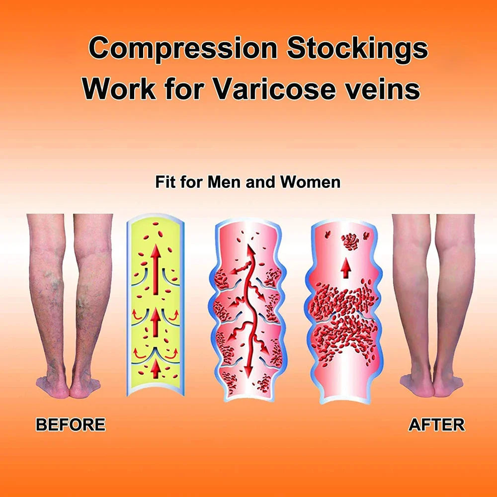 Manchons de Compression Médical pour Mollets - Traitement Varices