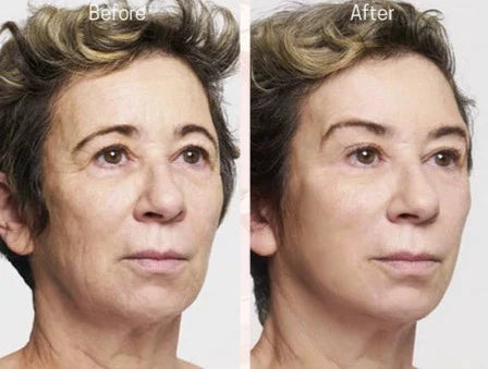 Face Lift - Adhésifs lifting invisible naturel