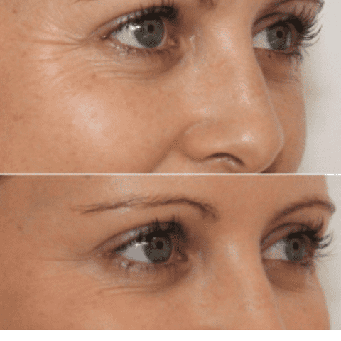 Patchs réutilisables anti-rides - 16 pièces