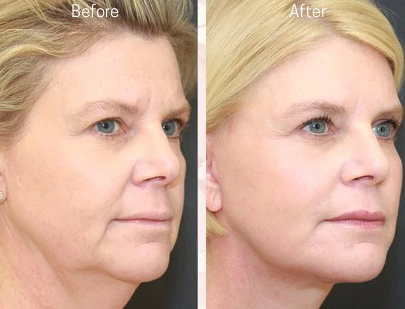 Face Lift - Adhésifs lifting invisible naturel