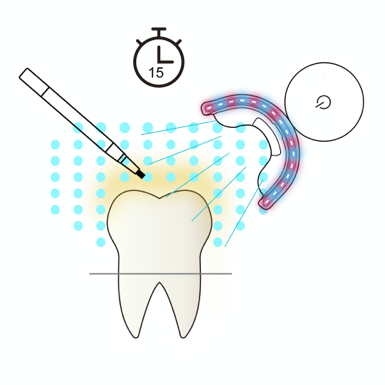 SMILEKIT - Kit de blanchiment dentaire Pro